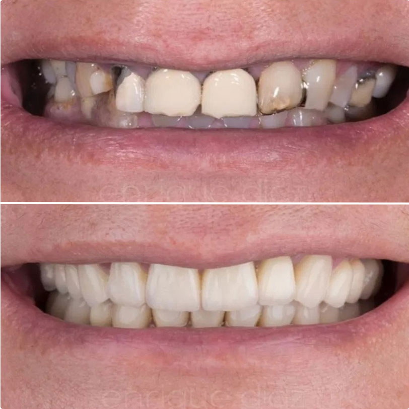 before and after photos of dental work at North Georgia Smiles