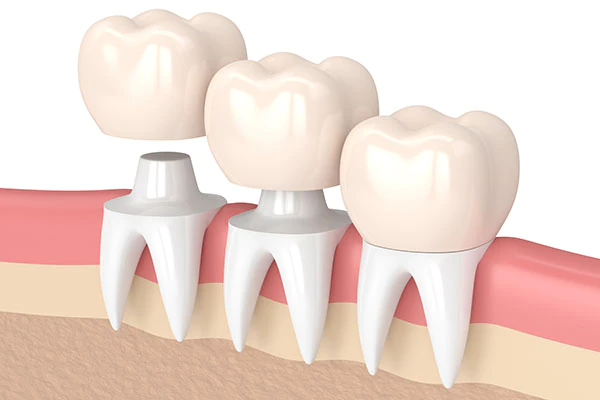 Dental Crowns vs. Tooth Extraction from North Georgia Smiles in Cumming, GA