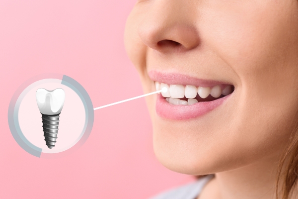 Pros and Cons of Dental Implants from North Georgia Smiles in Cumming, GA